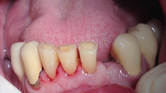  Before: This patient suffered with tooth loss and significant tooth wear/attrition.