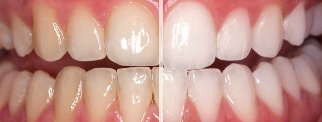  Example of how teeth whitening improves the appearance of the teeth.