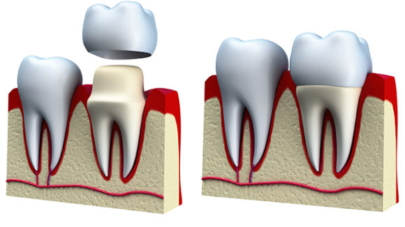  Example of how a crown fits onto a tooth.