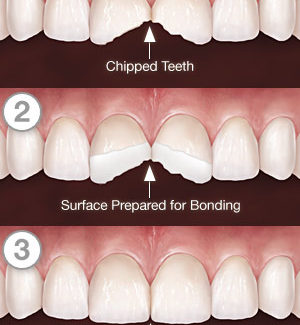  The process of dental bonding.