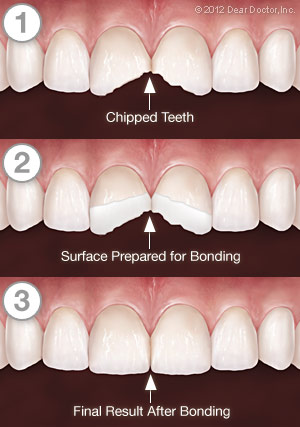  Example of how dental bonding improves the appearance of the teeth.
